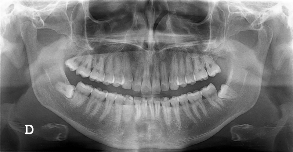 Digital Dental Sensors – The New Dental X-Rays